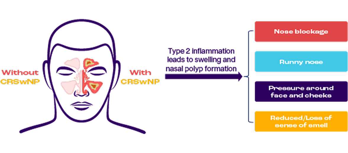 Infographic comparing a head without CRSwNP, showing clear nasal passages, to a head with CRSwNP, showing inflamed nasal passages with polyps. Text explains that Type 2 inflammation leads to swelling and nasal polyp formation, resulting in nose blockage, runny nose, pressure around the face and cheeks, and reduced or loss of sense of smell.